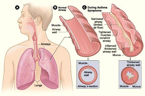 Figure A shows the location of the lungs and airways in the body. Figure B shows a cross-section of a normal airway. Figure C shows a cross-section of an airway during asthma symptoms.