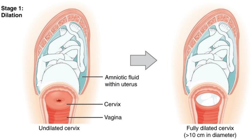 Figure 3.2 - Early cervical dilation.