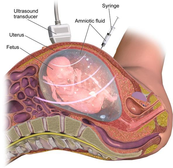 Image of Amniocentesis.