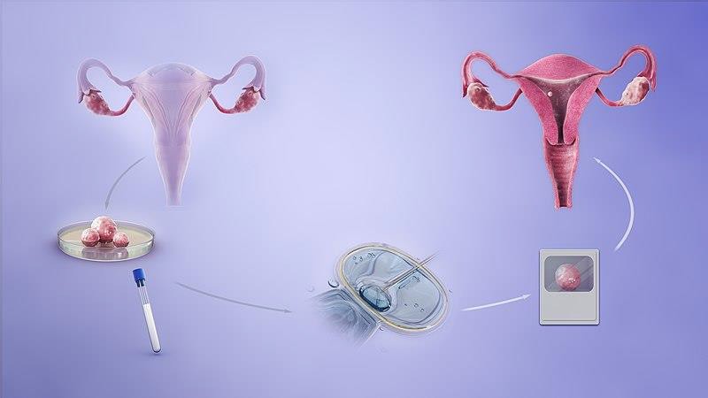 The IVF process.