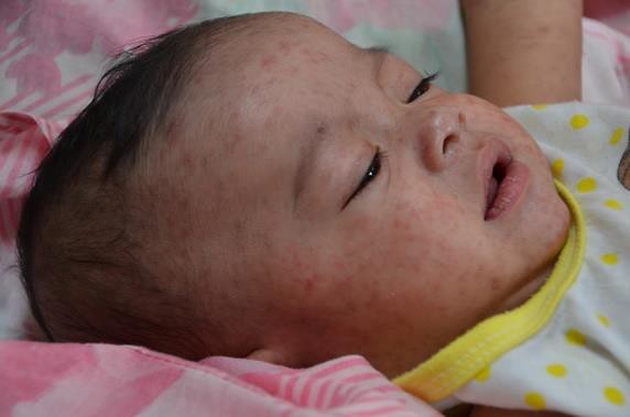 A baby with measles