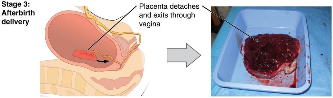 delivery of the placenta and associated fetal membranes.